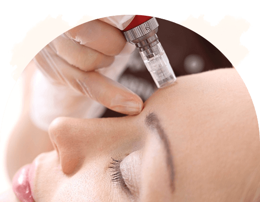 Dermapen behandeling Dronten