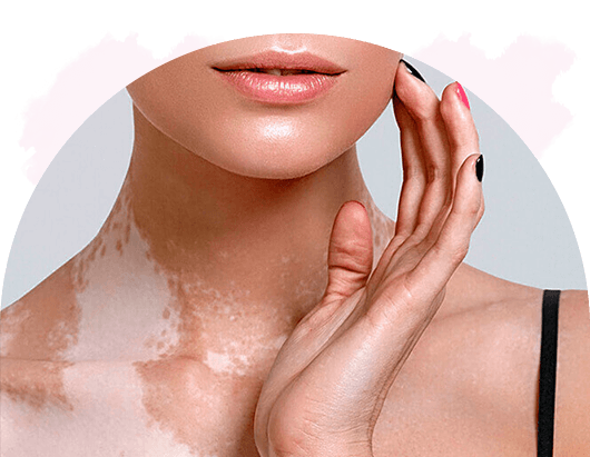 Camouflage behandeling Dronten